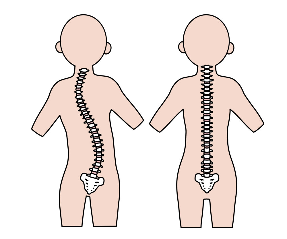 ピラティスで側弯症を改善!効果的な頻度と安全なスタジオの選び方